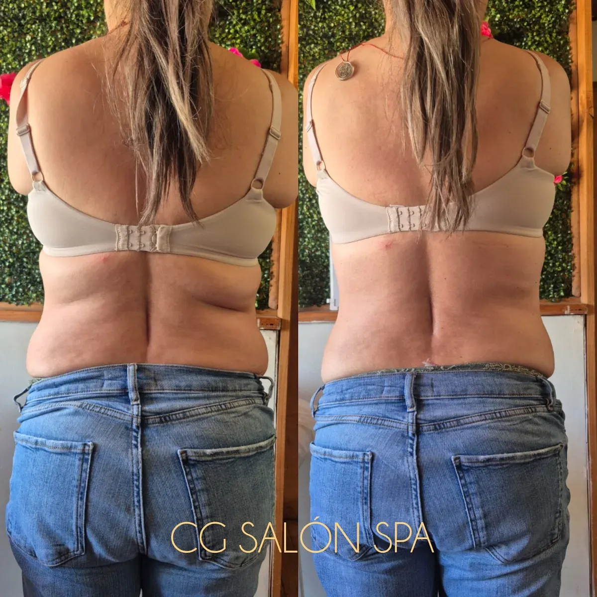 Antes y después de tratamiento corporal reductivo realizado en CG Salón Spa