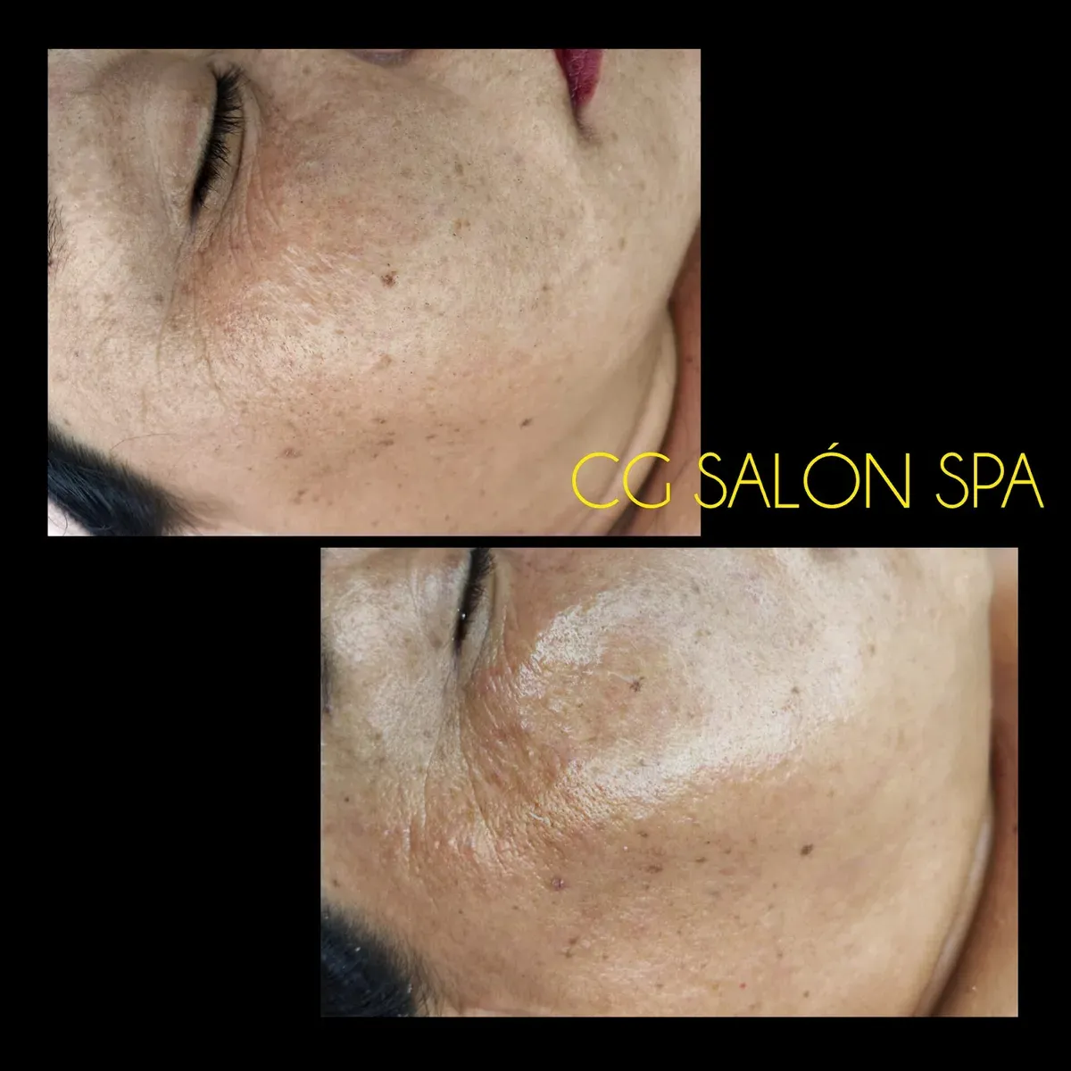 Antes y después de tratamiento facial realizado en CG Salón Spa
